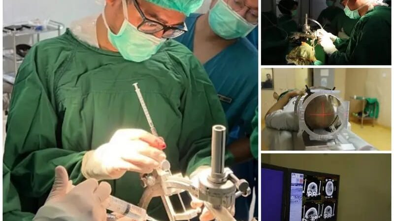 RSUP H Adam Malik Berhasil Angkat Tumor di Dasar Tengkorak Pasien