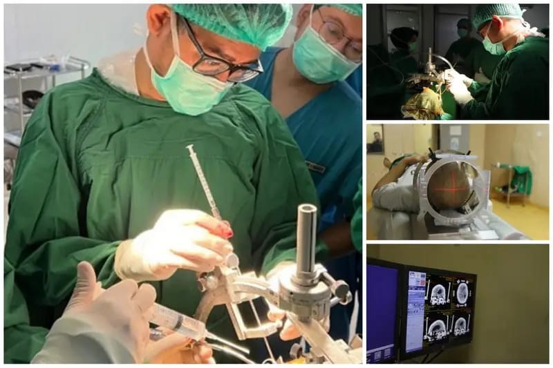 RSUP H Adam Malik Berhasil Angkat Tumor di Dasar Tengkorak Pasien